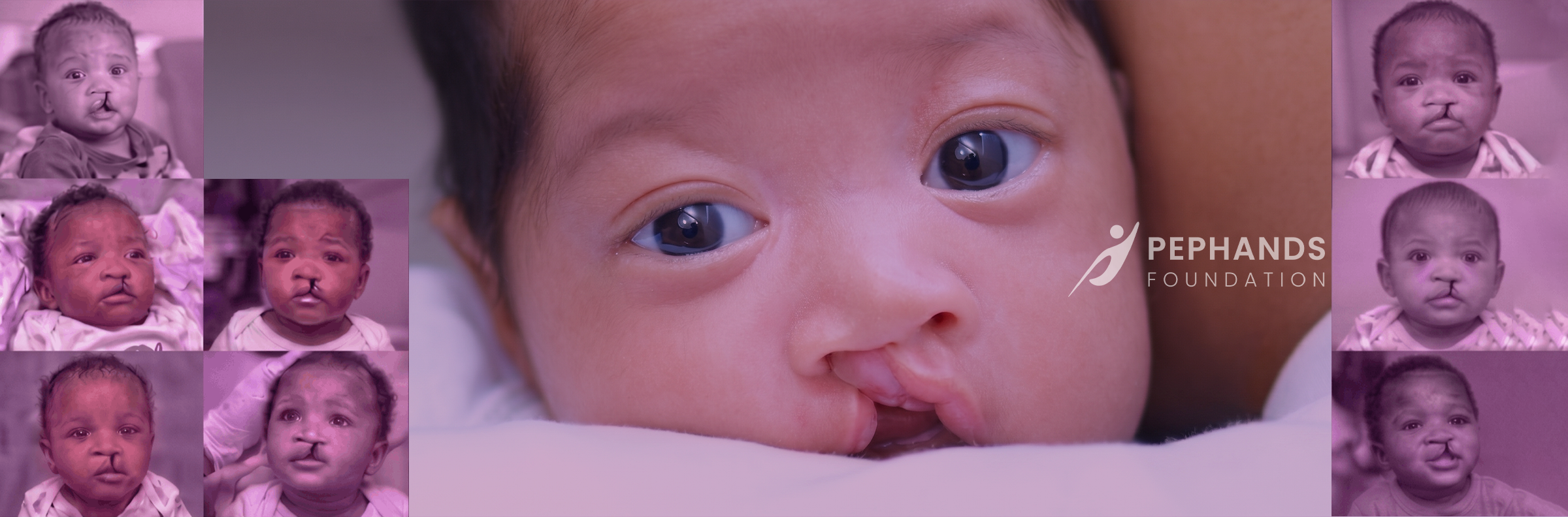 cleft surgeries by pephands